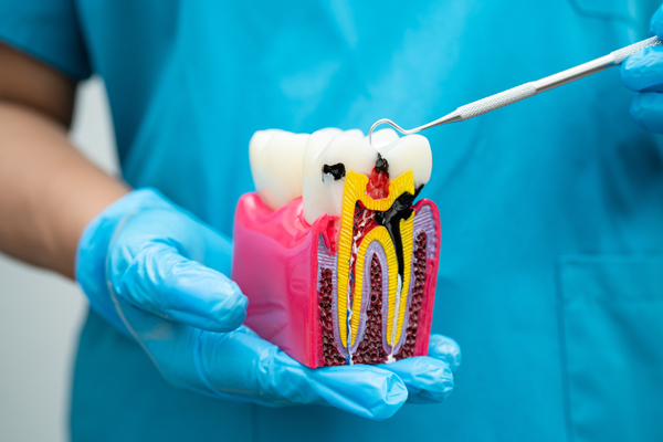 Signs Your Tooth May Need A Root Canal