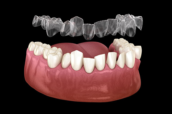 The Ideal Candidate For Invisalign